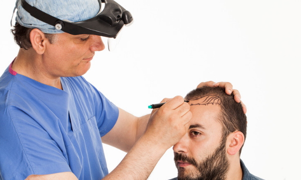 Why do Hair Transplant Results may change