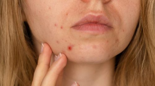 Mental Health and Acne